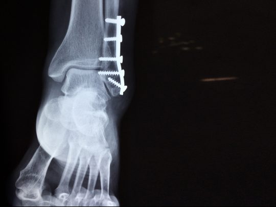 Ankle Fracture Surgery  Orthopedics Sports Medicine